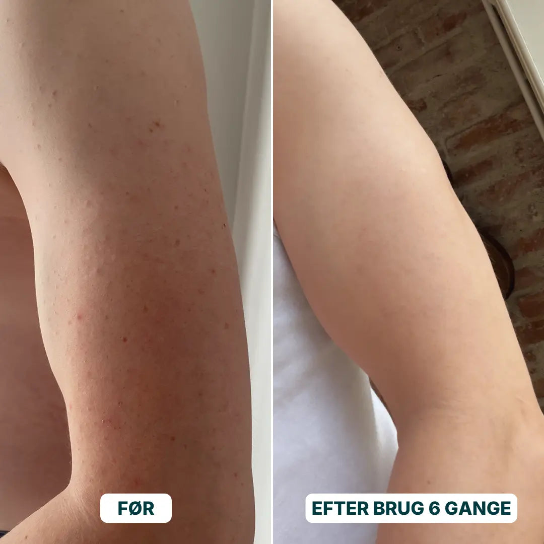 Eksfolieringshandske