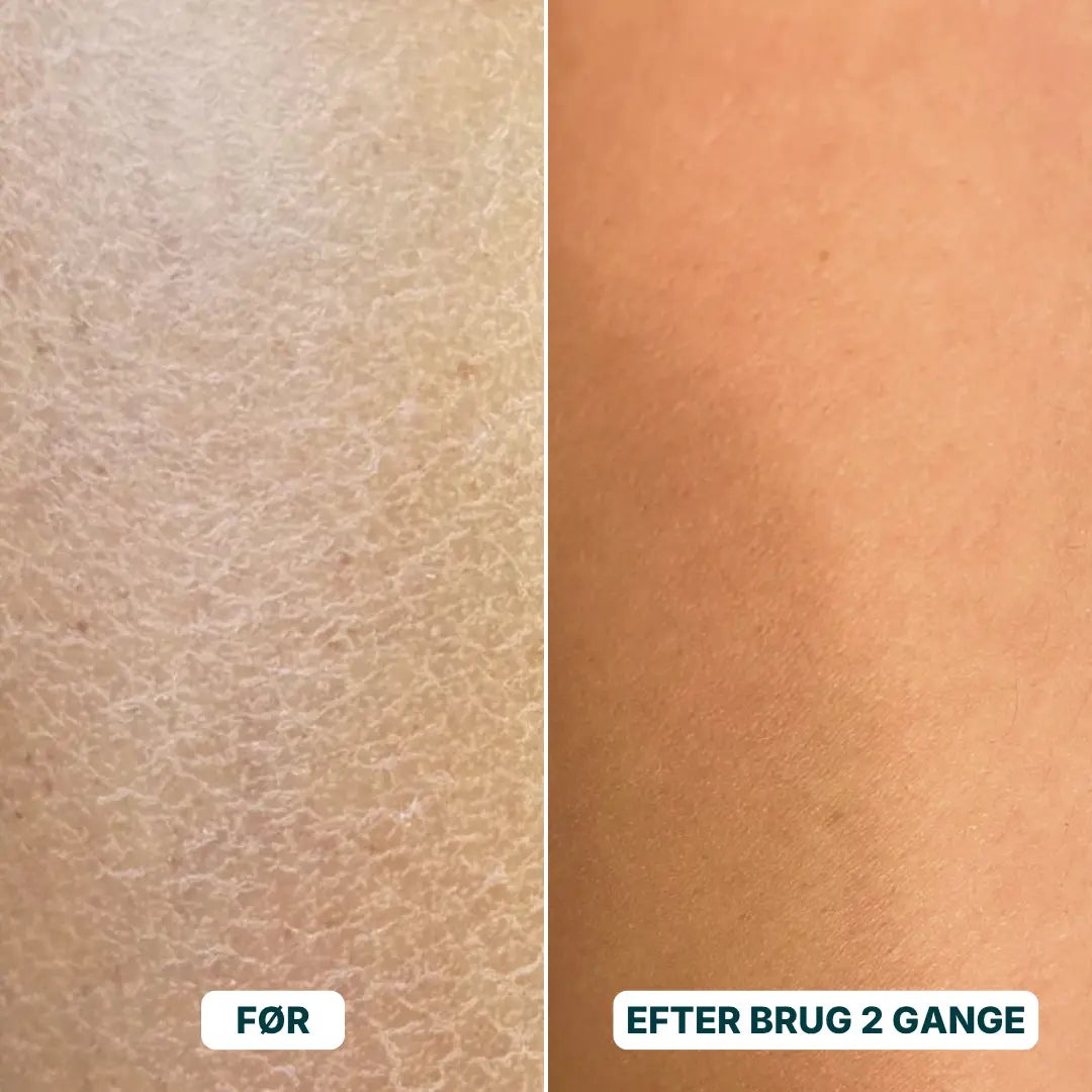 Eksfolieringshandske