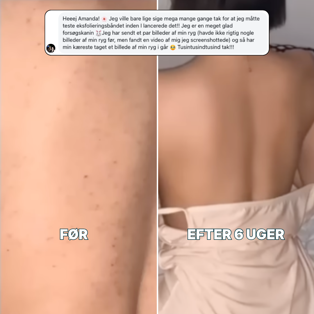 Gen-Exfo™ Eksfolieringsbånd